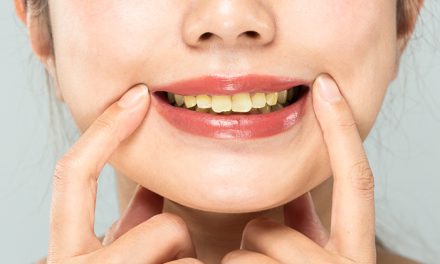 Cara Mencegah Noda Kuning Di Gigi Tanpa Pemutih Kimia