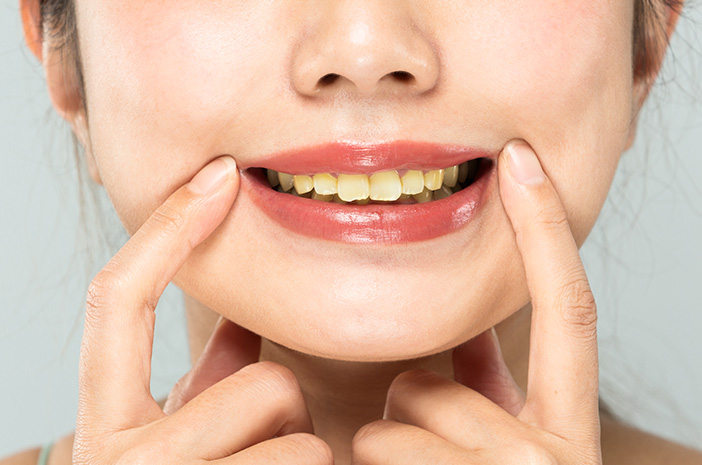 Cara Mencegah Noda Kuning Di Gigi Tanpa Pemutih Kimia