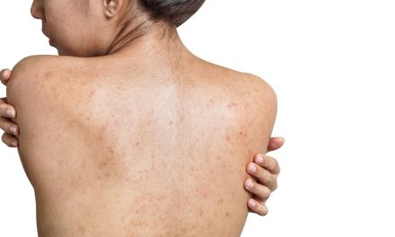 Awas Jerawat Punggung! Bahaya Biarkan Keringat Kering Sendiri