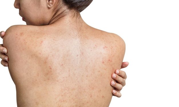Awas Jerawat Punggung! Bahaya Biarkan Keringat Kering Sendiri